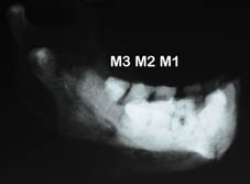 LB1 molar x-ray